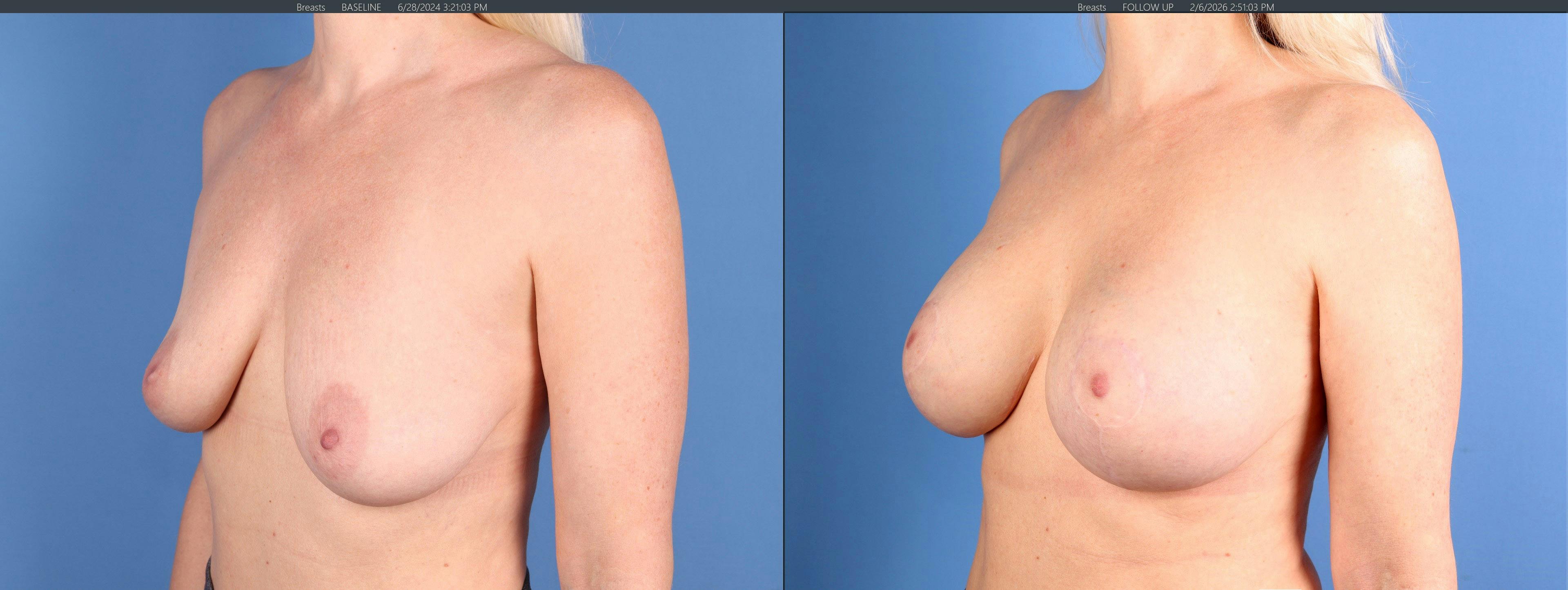 Breast Lift with Augmentation Before & After Gallery - Patient 115933 - Image 2