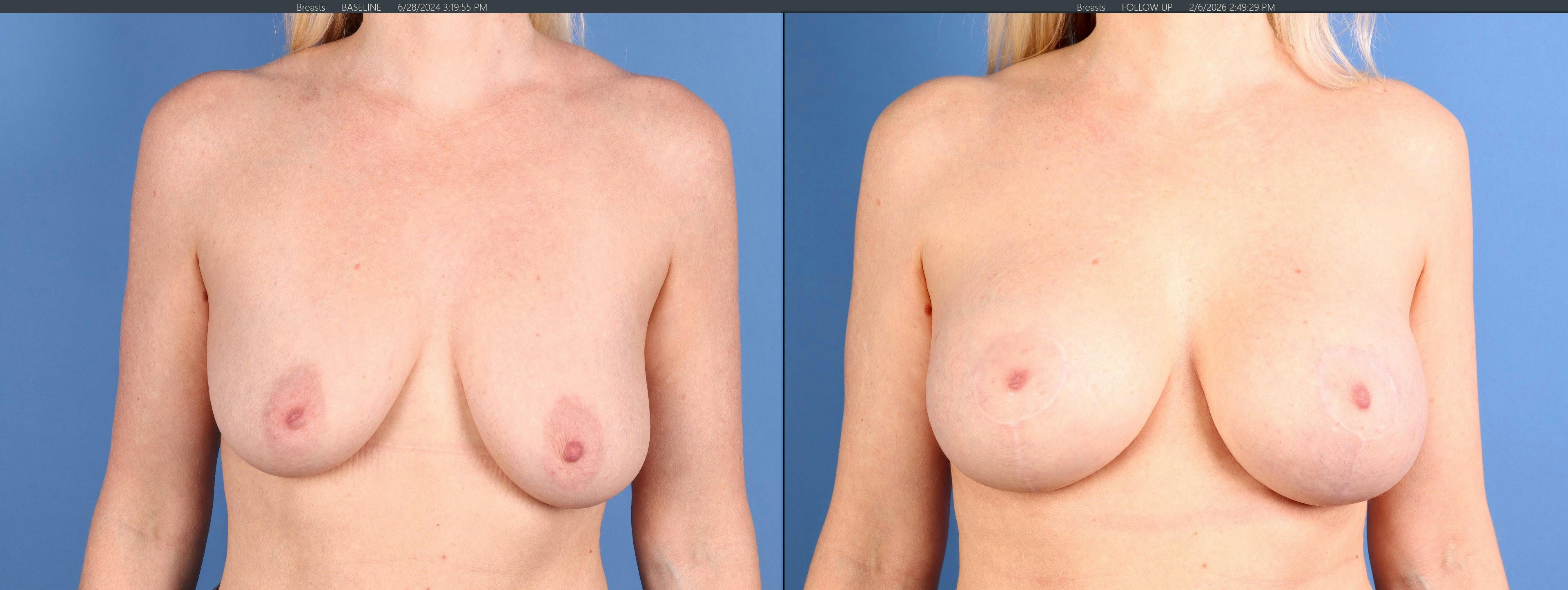 Breast Lift with Augmentation Before & After Gallery - Patient 115933 - Image 1