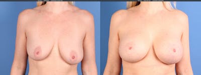Breast Lift with Augmentation Before & After Gallery - Patient 115933 - Image 1