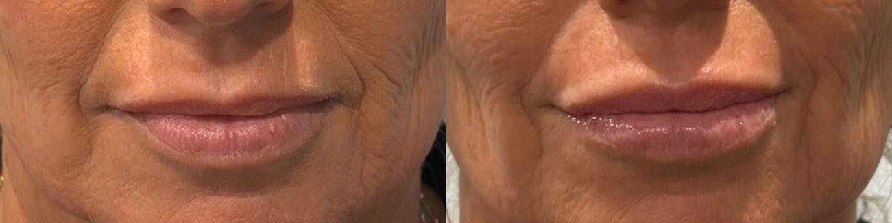 Lip Augmentation Before & After Gallery - Patient 418342 - Image 1