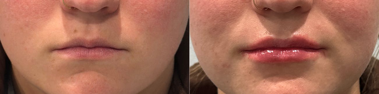 Lip Augmentation Before & After Gallery - Patient 280979 - Image 1