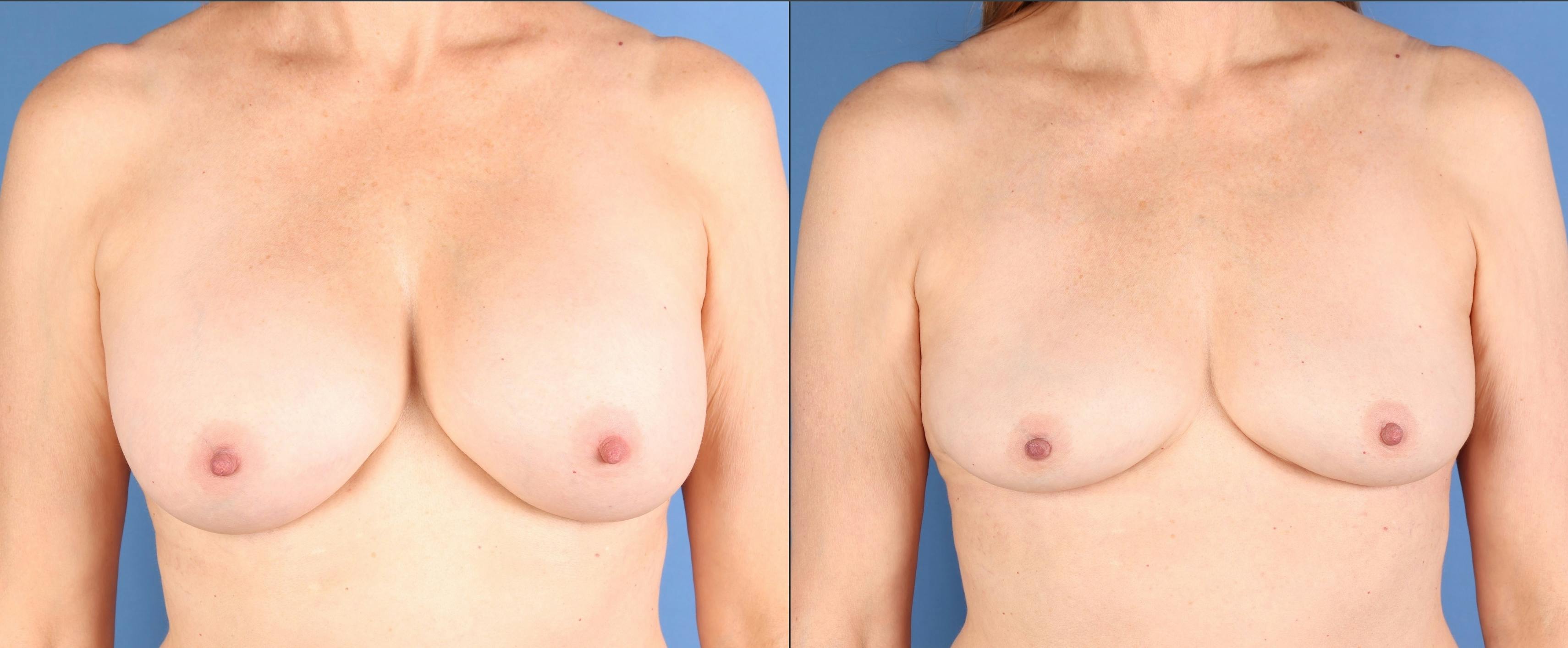 Breast Implant Removal Before & After Gallery - Patient 814617 - Image 1