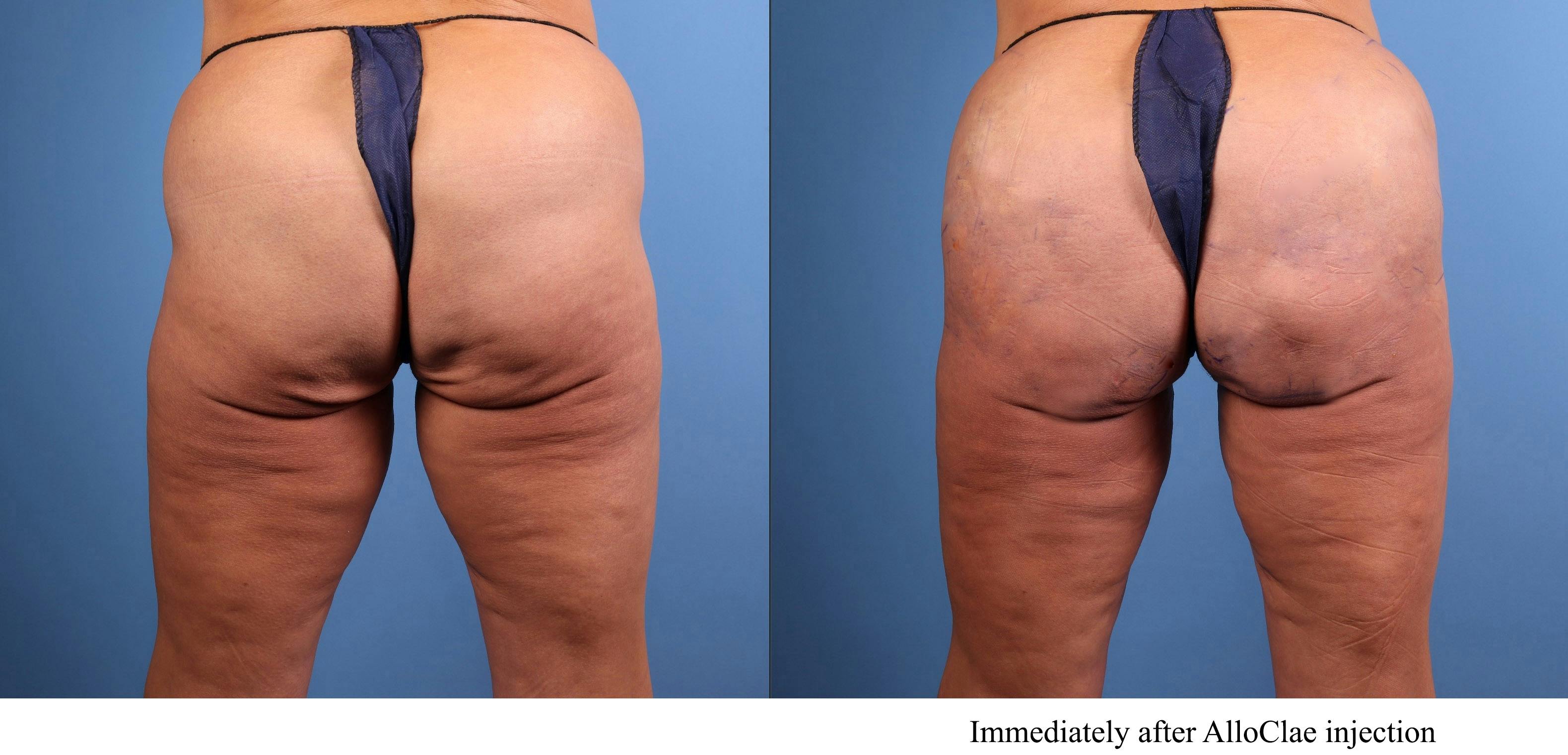 Brazilian Buttock Lift Before & After Gallery - Patient 222254 - Image 1