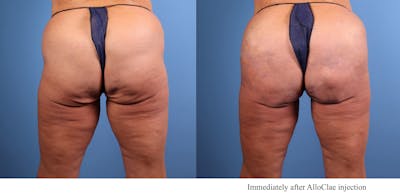 Brazilian Buttock Lift Before & After Gallery - Patient 222254 - Image 1