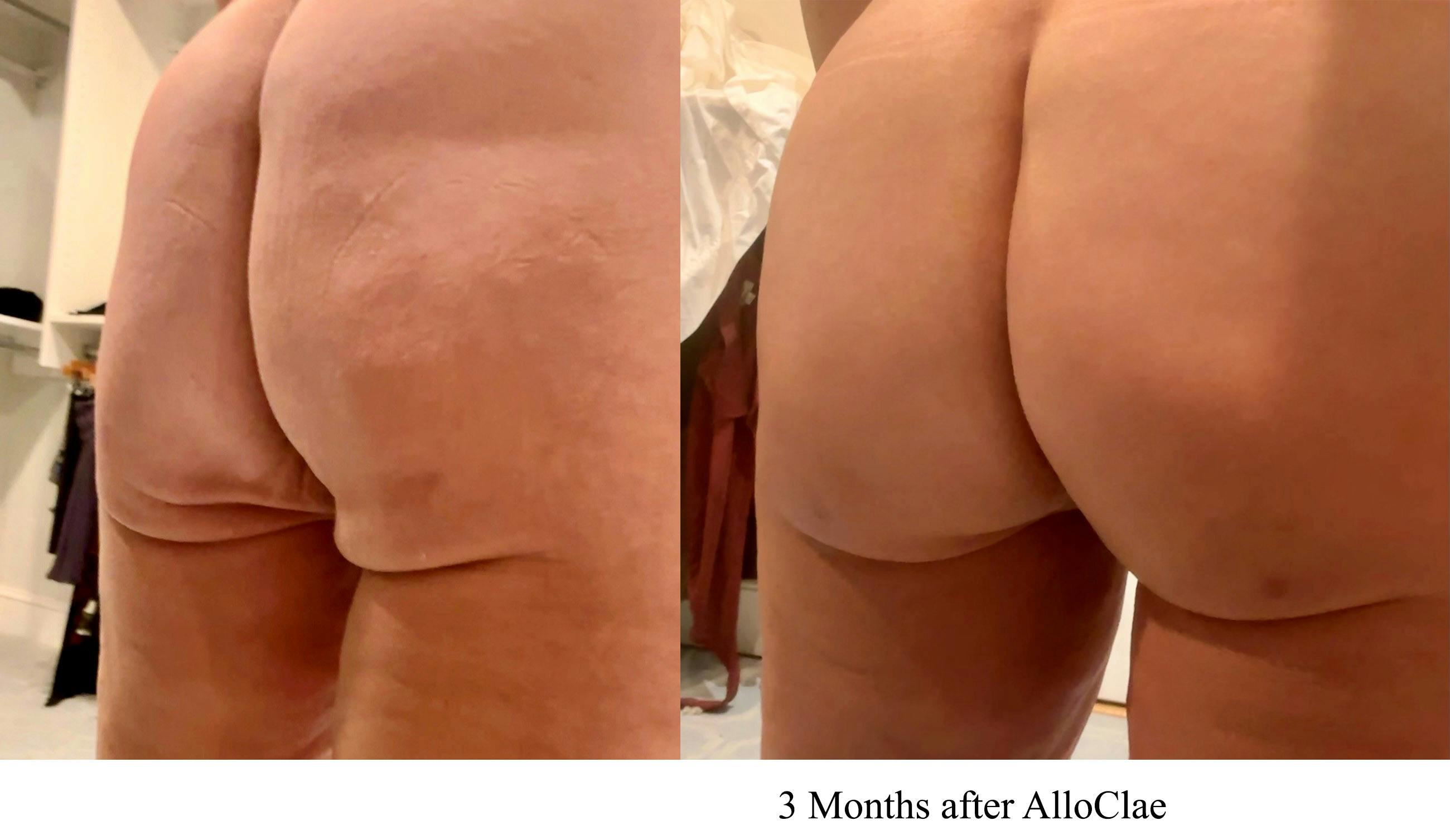 Brazilian Buttock Lift Before & After Gallery - Patient 222254 - Image 3