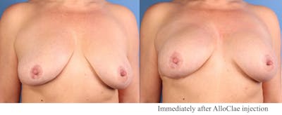 AlloClae Before & After Gallery - Patient 163785 - Image 1