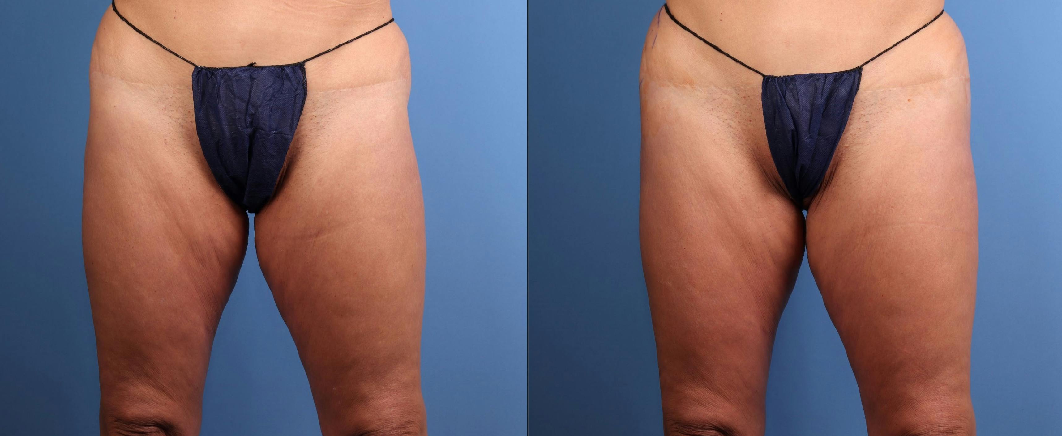 Brazilian Buttock Lift Before & After Gallery - Patient 222254 - Image 2