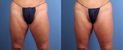 Hip Dip Correction Before & After Gallery - Patient 370881 - Image 1