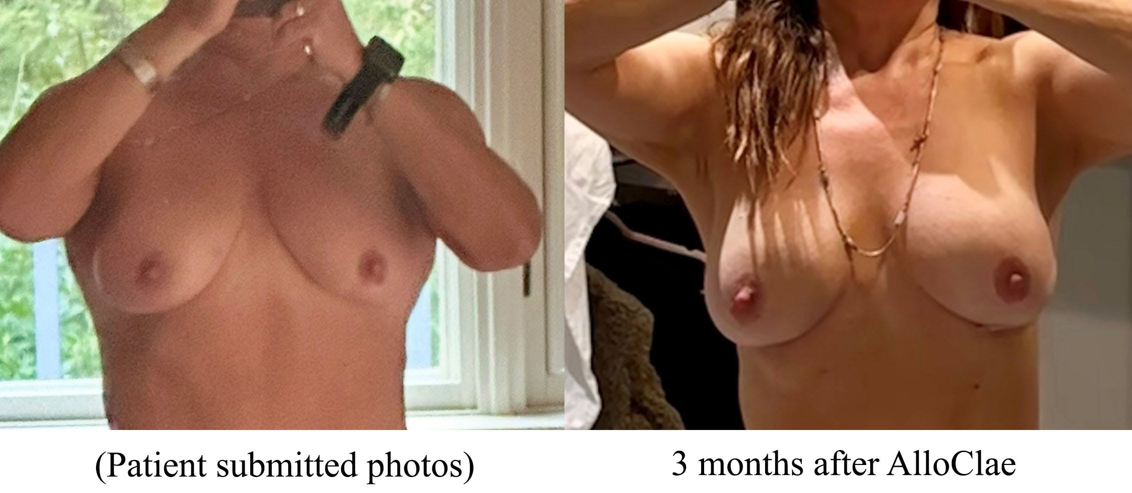 Fat Transfer Breast Augmentation Before & After Gallery - Patient 155330 - Image 3