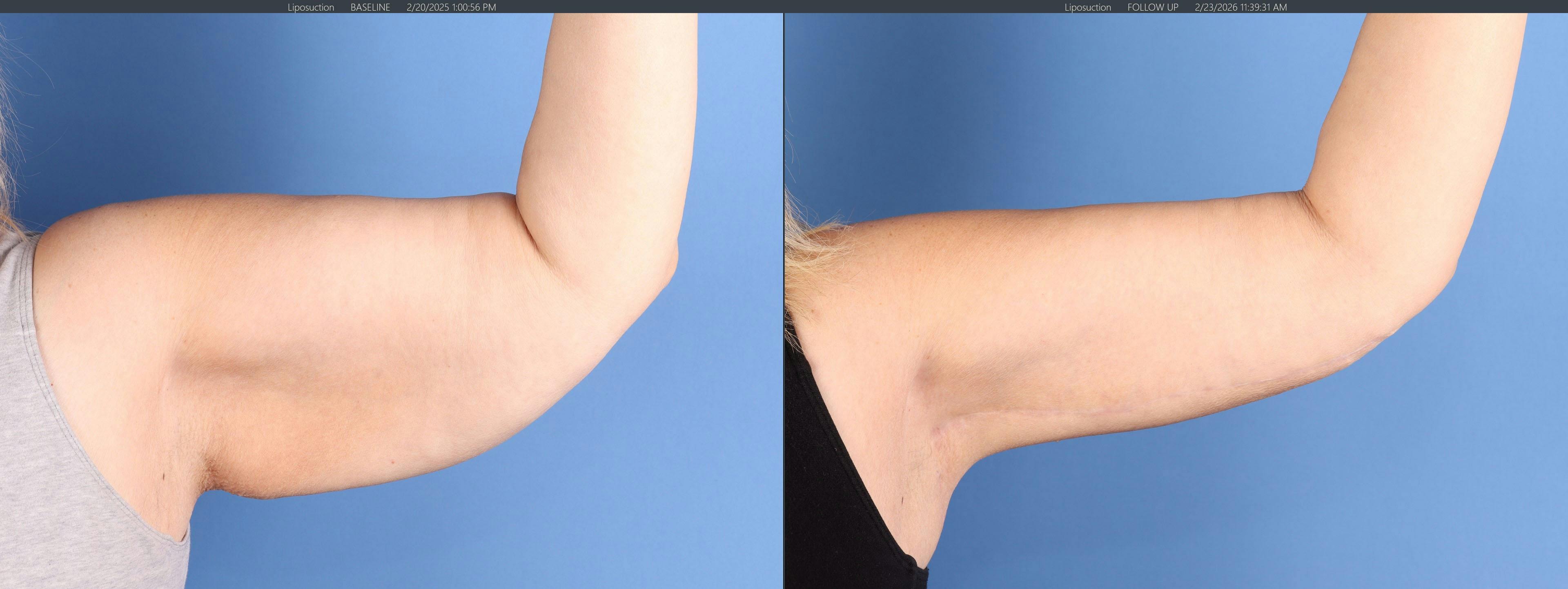 Arm Lift Before & After Gallery - Patient 232912 - Image 3