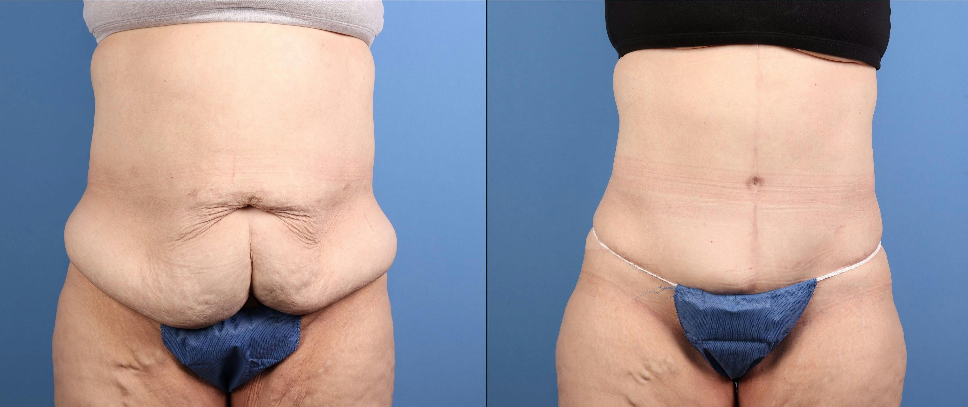 Tummy Tuck Before & After Gallery - Patient 803326 - Image 1