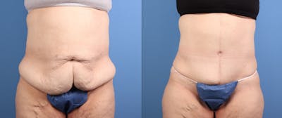 Tummy Tuck Before & After Gallery - Patient 243081 - Image 1
