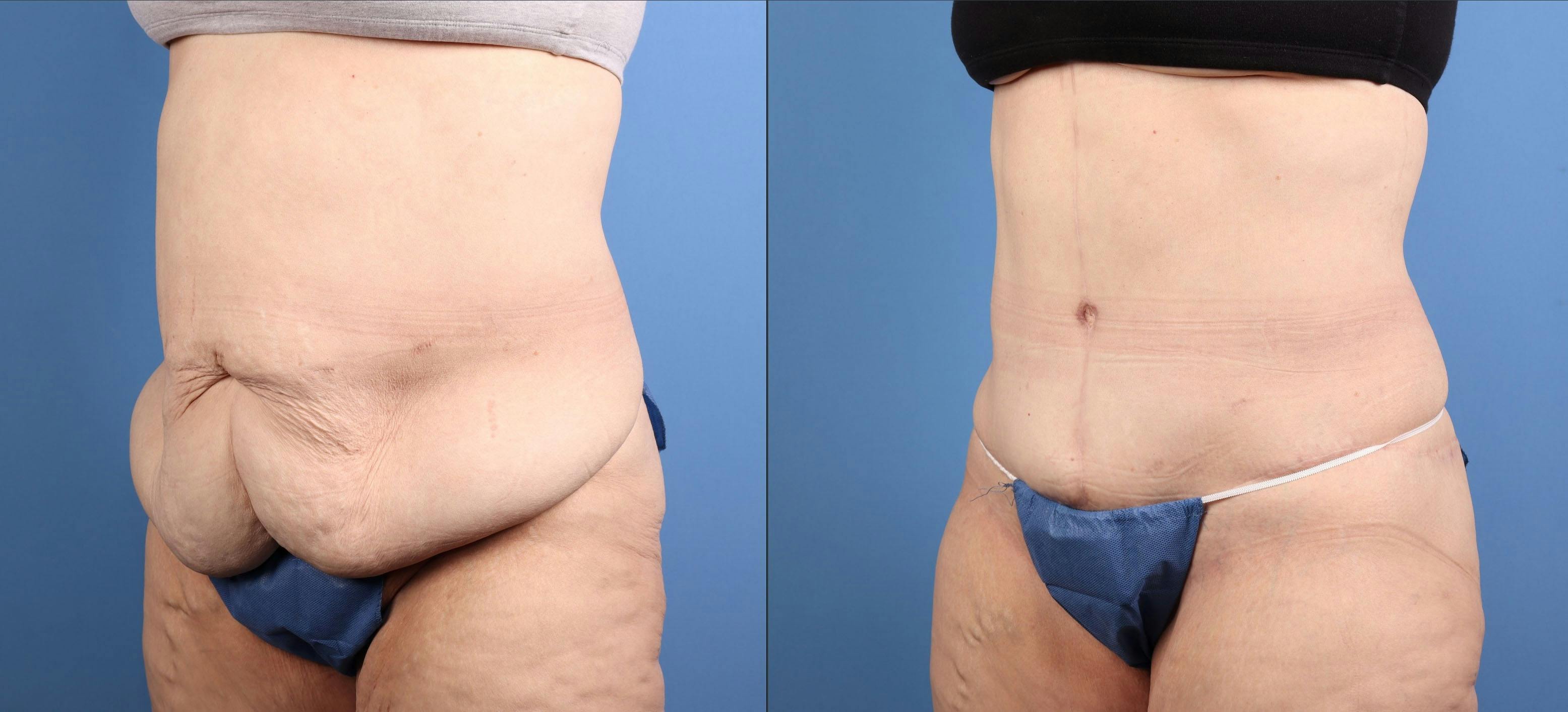 Tummy Tuck Before & After Gallery - Patient 803326 - Image 2