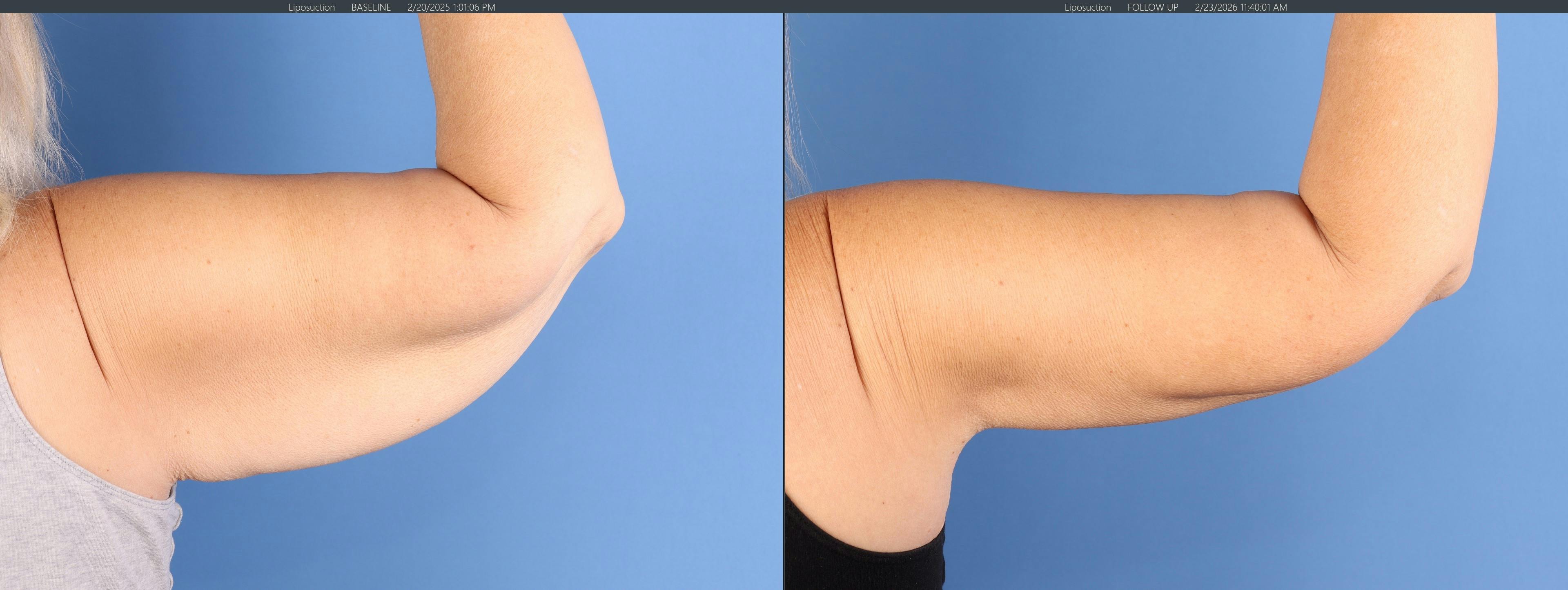 Arm Lift Before & After Gallery - Patient 232912 - Image 2