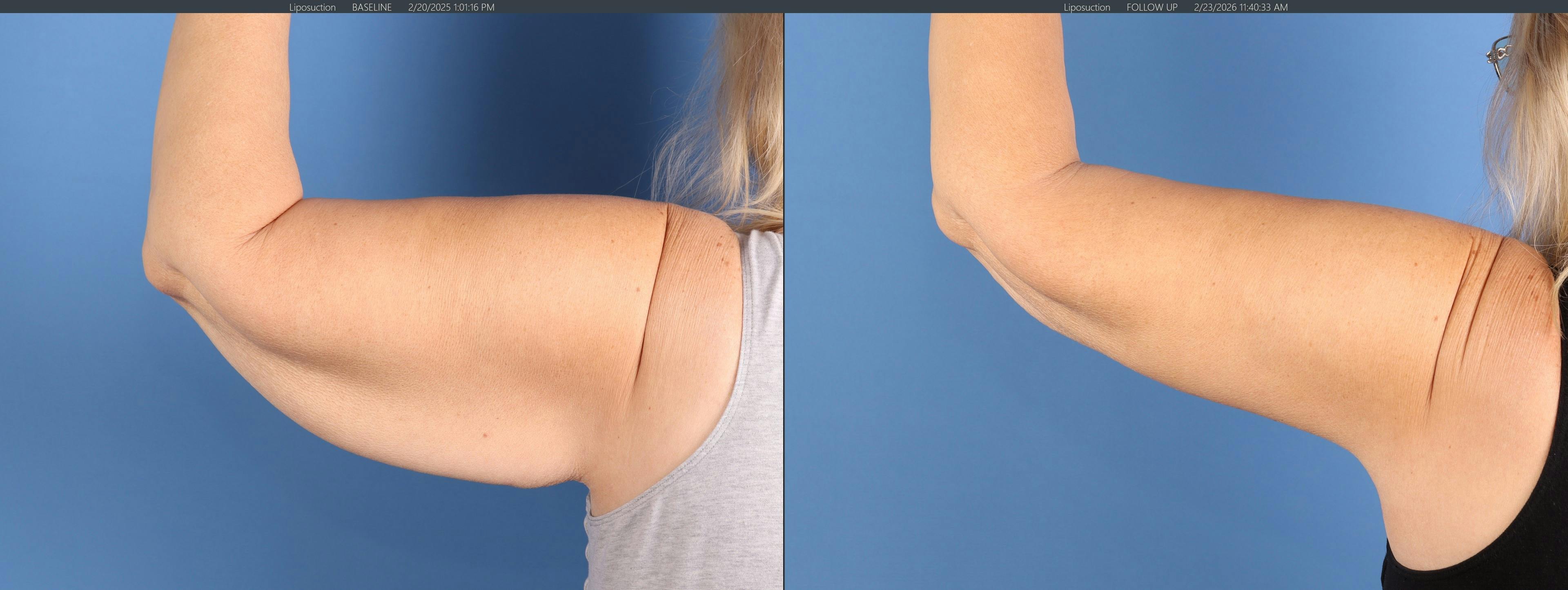 Arm Lift Before & After Gallery - Patient 232912 - Image 1