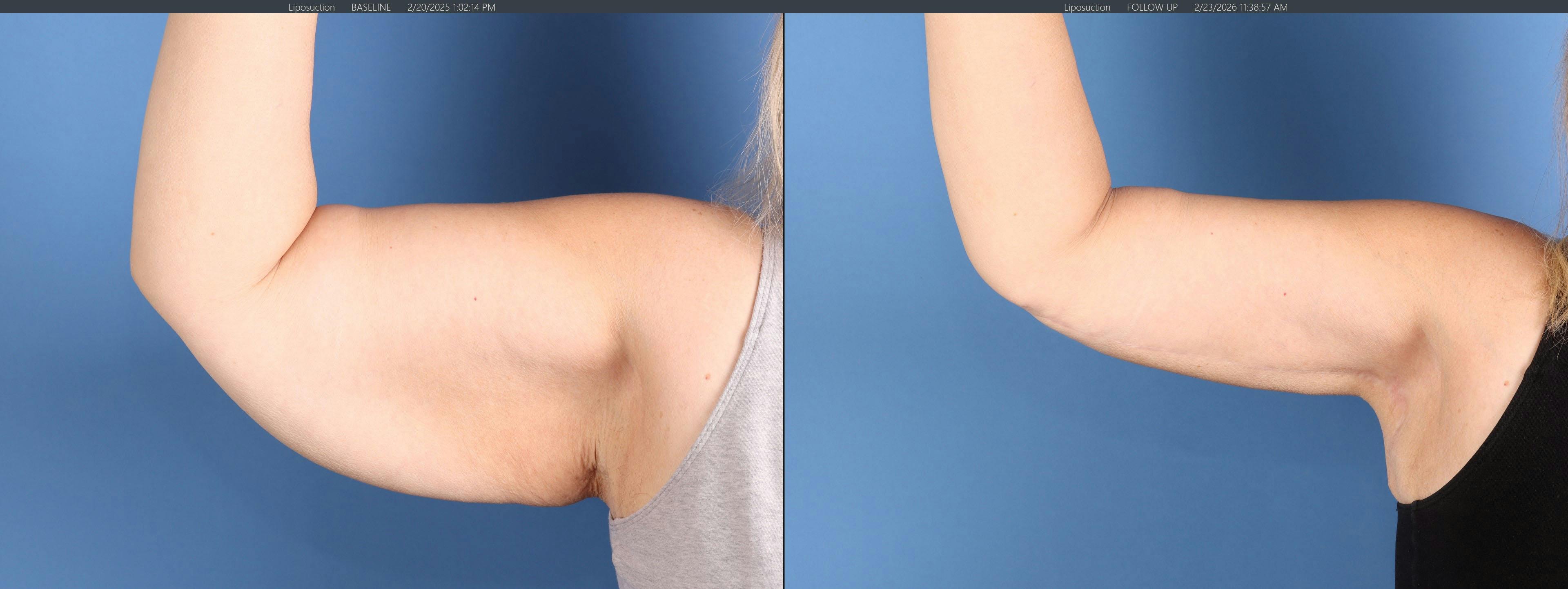 Arm Lift Before & After Gallery - Patient 232912 - Image 4