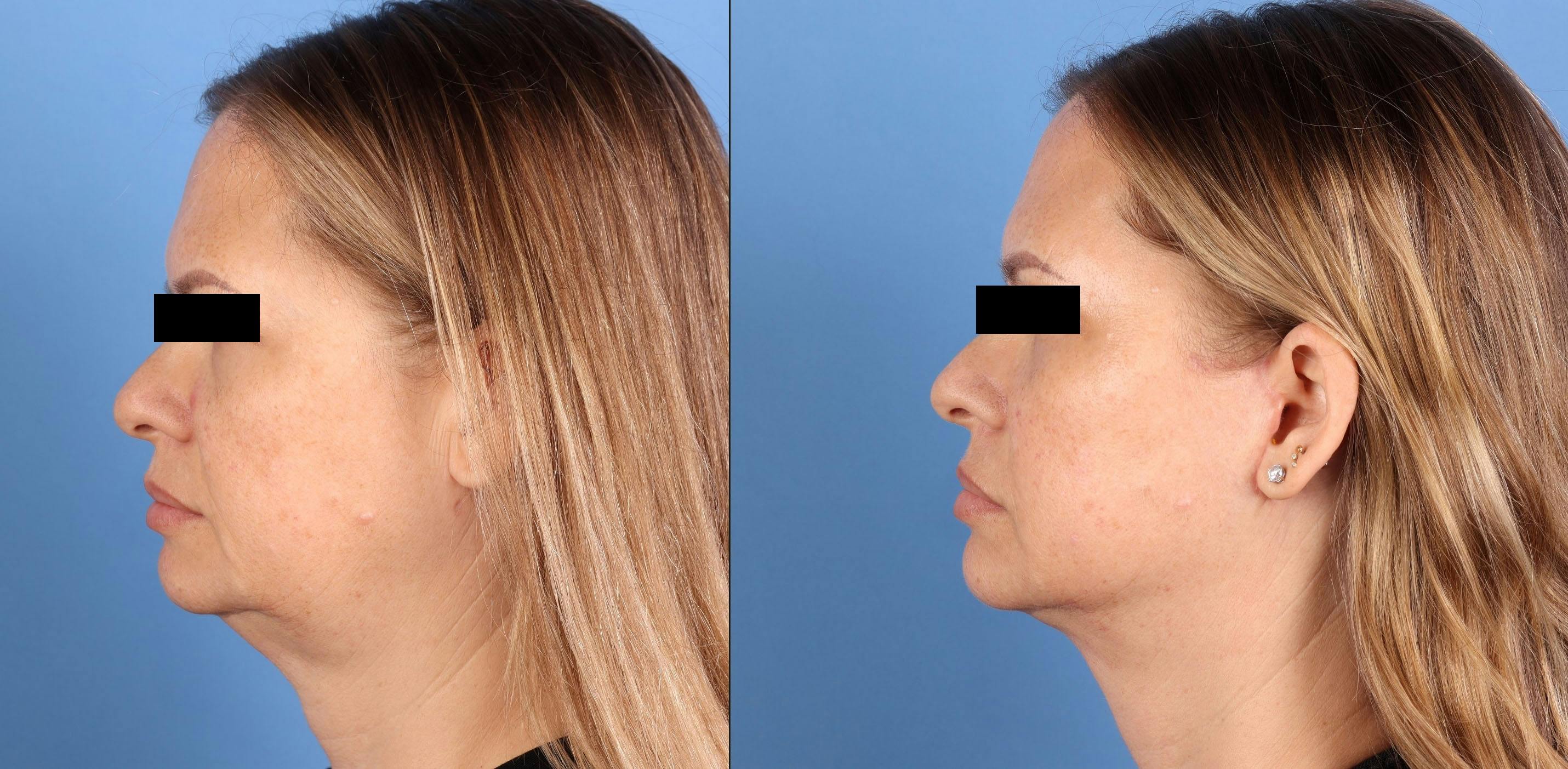 Face Lift Before & After Gallery - Patient 197204 - Image 3