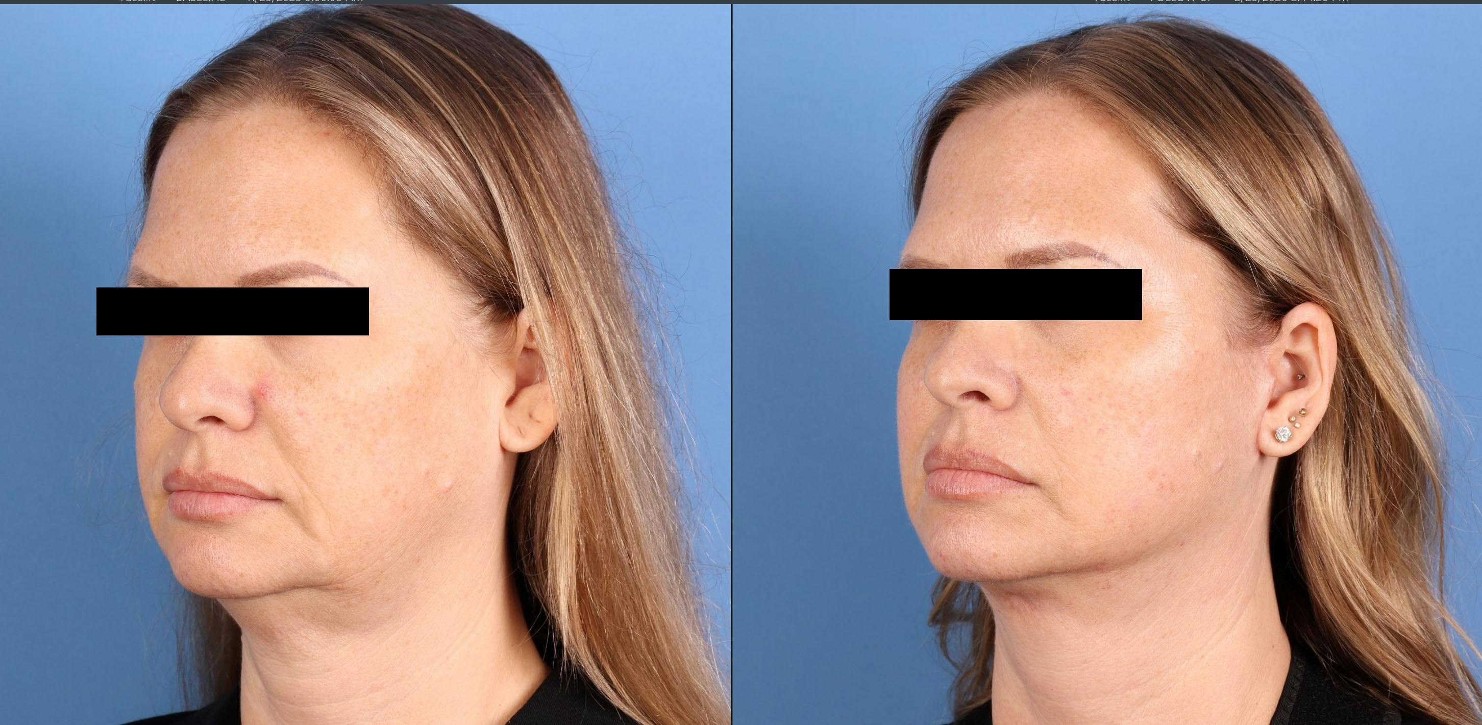 Face Lift Before & After Gallery - Patient 197204 - Image 2