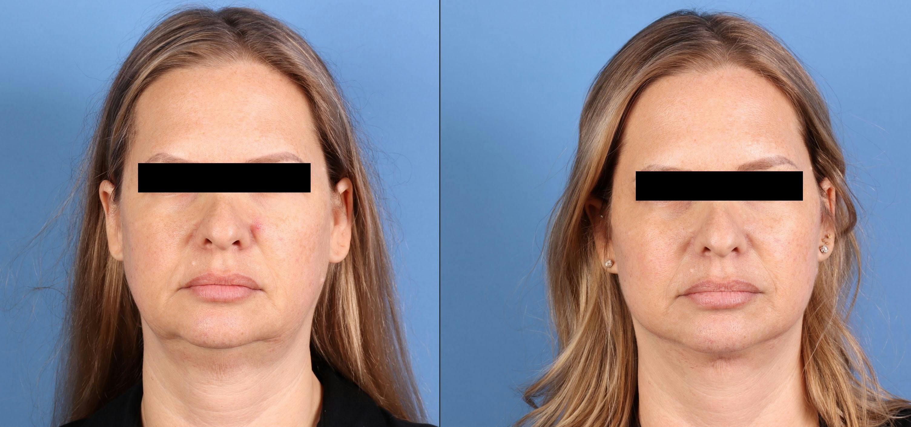 Face Lift Before & After Gallery - Patient 197204 - Image 1