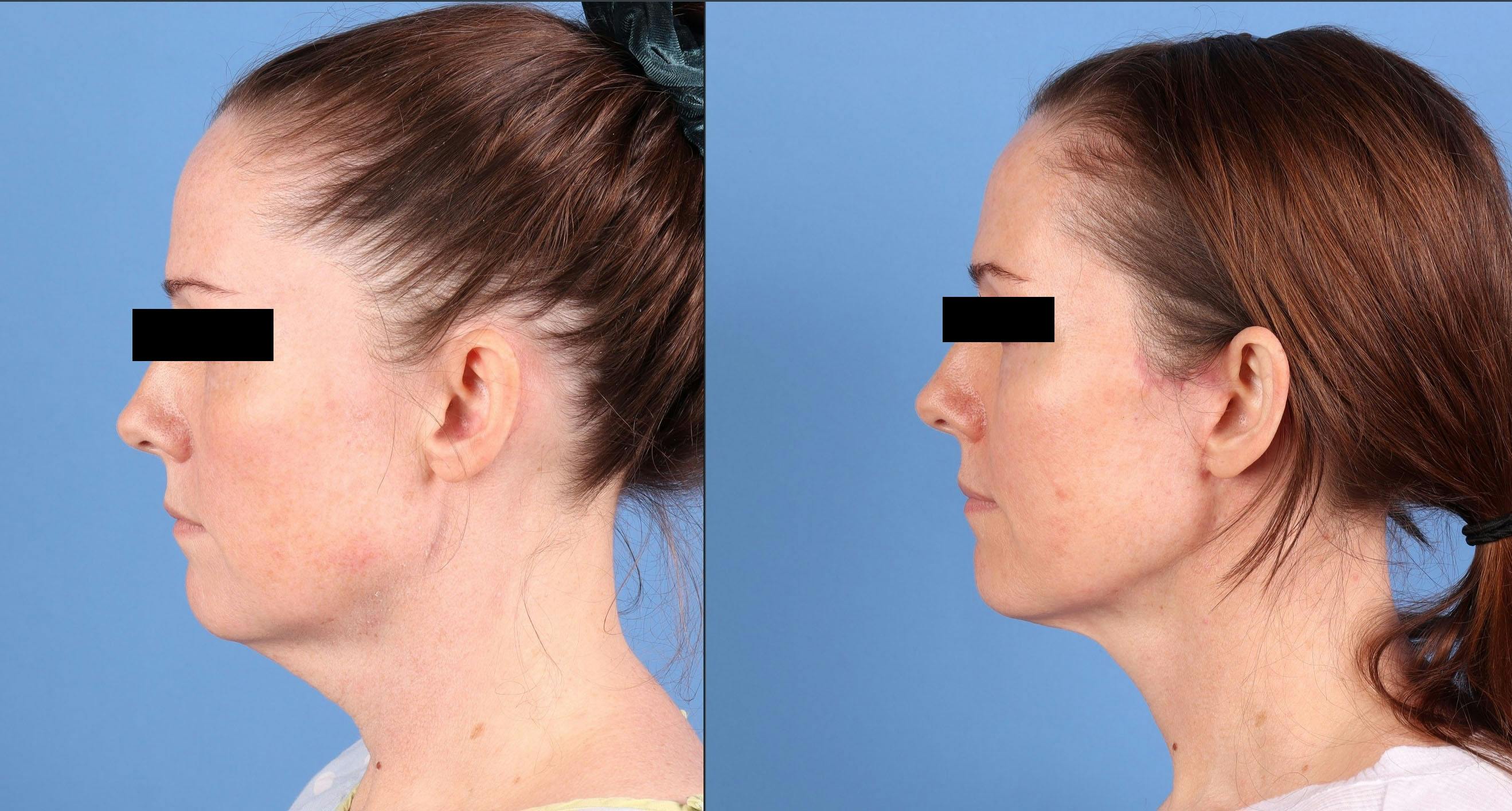 Neck Lift Before & After Gallery - Patient 385221 - Image 1