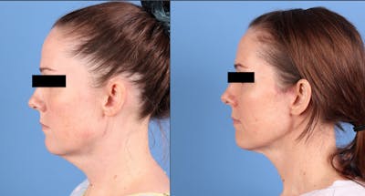 Neck Lift Before & After Gallery - Patient 385221 - Image 1