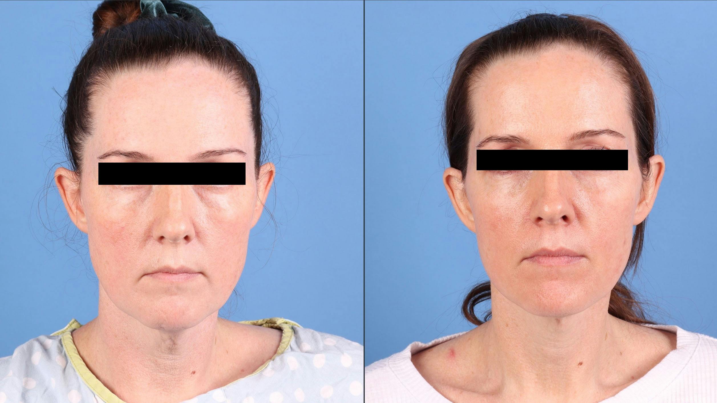 Neck Lift Before & After Gallery - Patient 385221 - Image 3