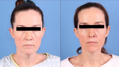 Face Lift Before & After Gallery - Patient 326090 - Image 1