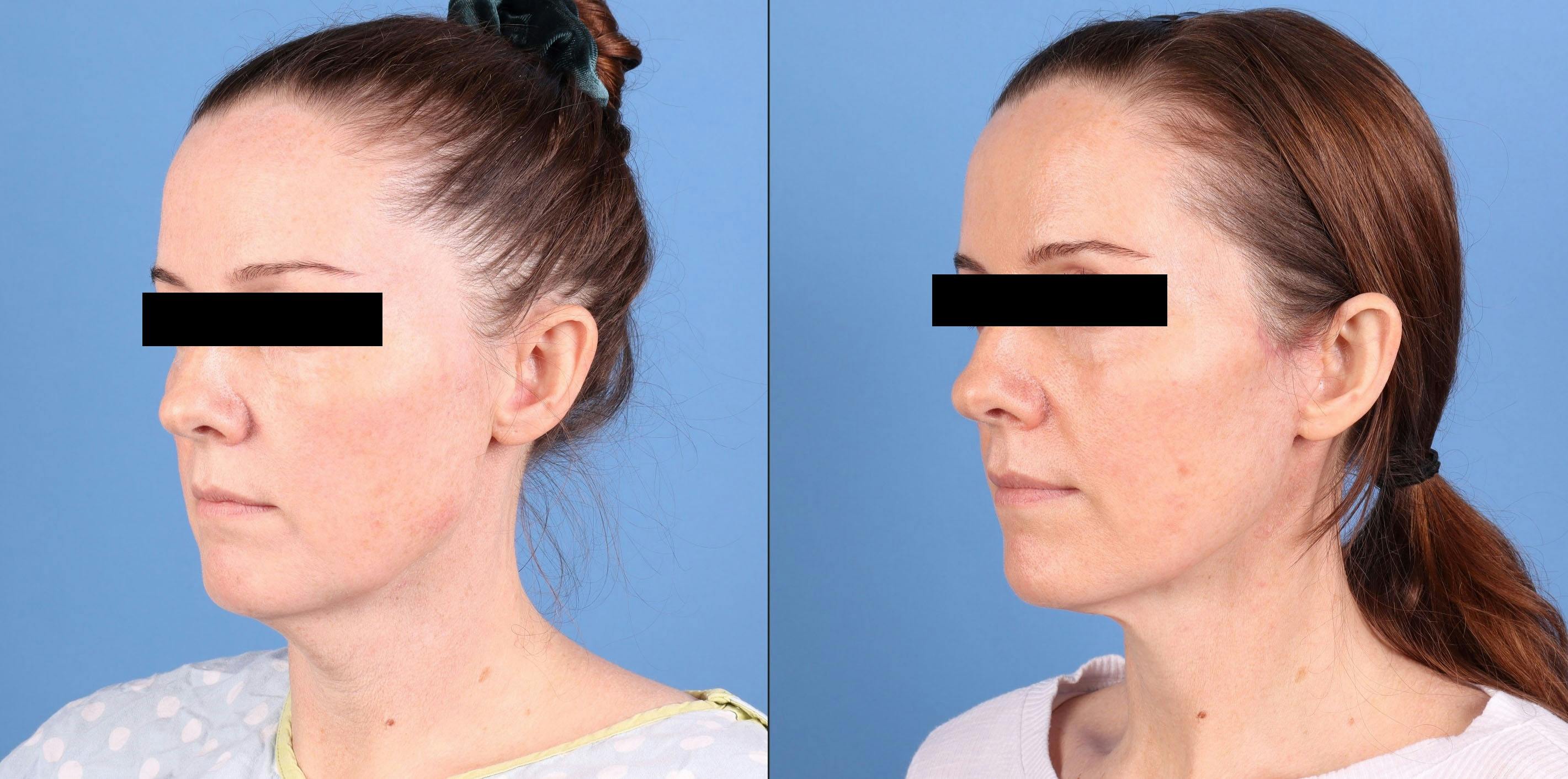 Neck Lift Before & After Gallery - Patient 385221 - Image 2