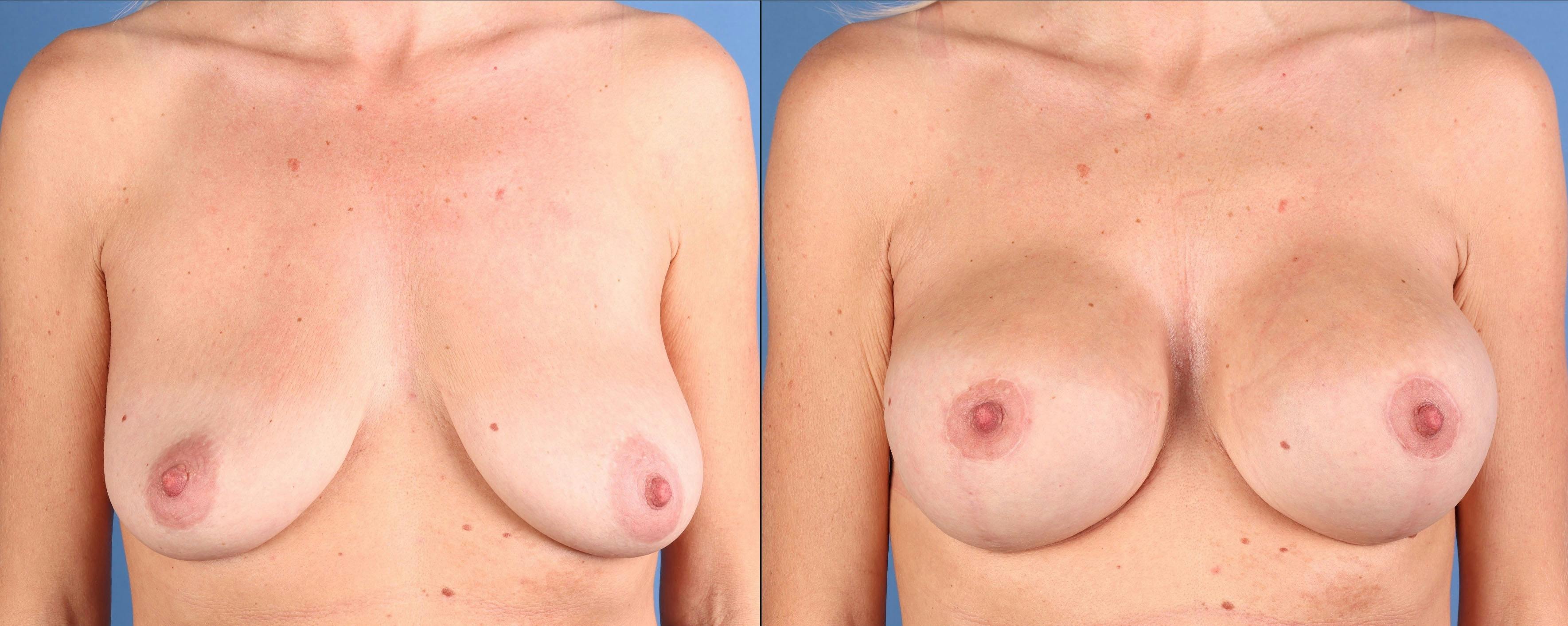 Breast Lift with Augmentation Before & After Gallery - Patient 320435 - Image 1