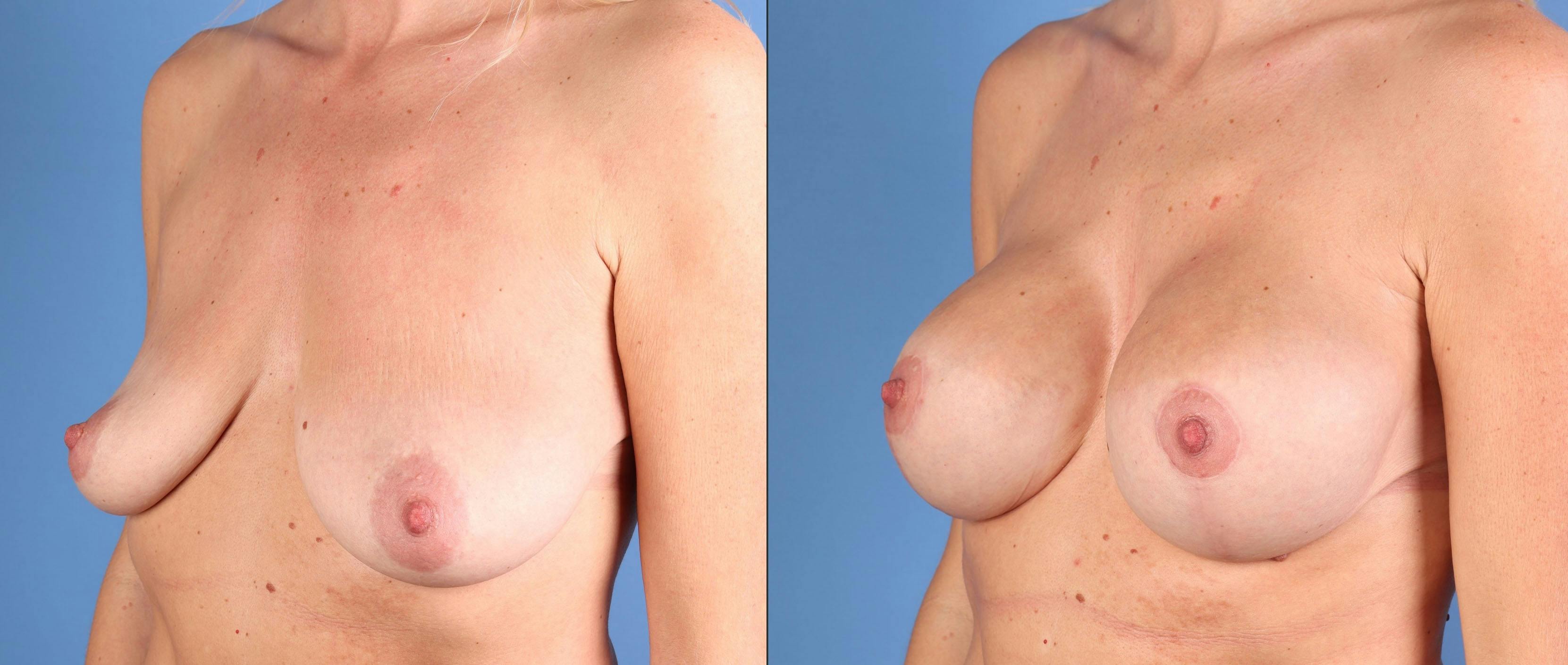 Breast Lift with Augmentation Before & After Gallery - Patient 320435 - Image 2