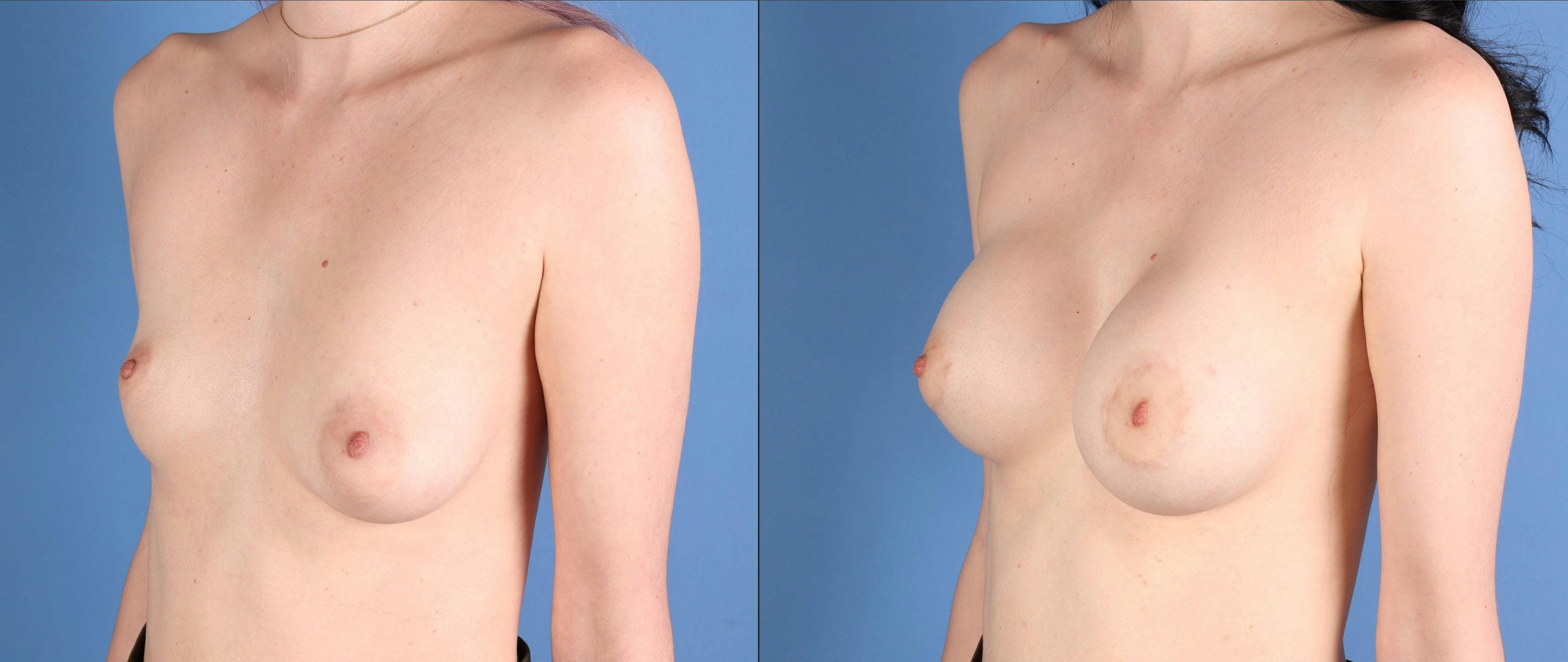 Breast Augmentation Before & After Gallery - Patient 199658 - Image 4