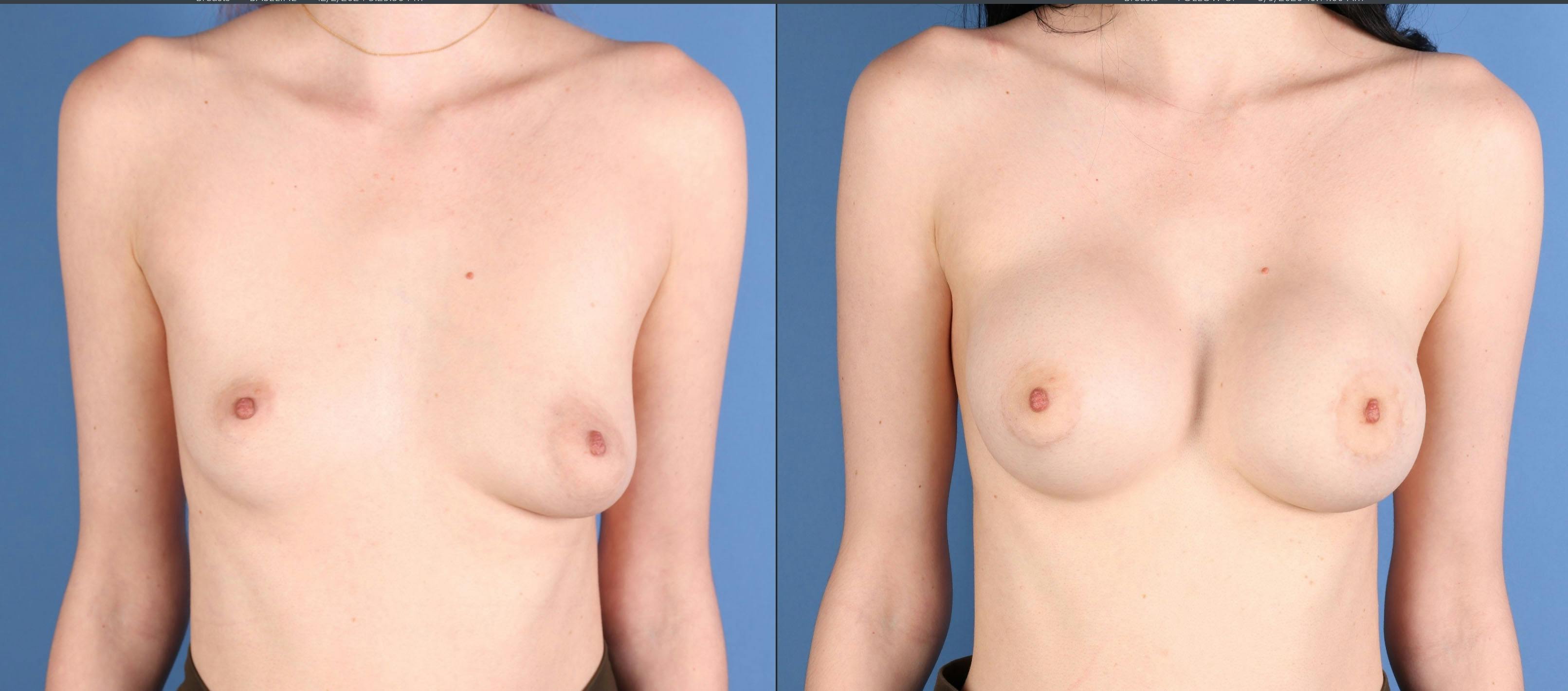 Breast Augmentation Before & After Gallery - Patient 199658 - Image 1