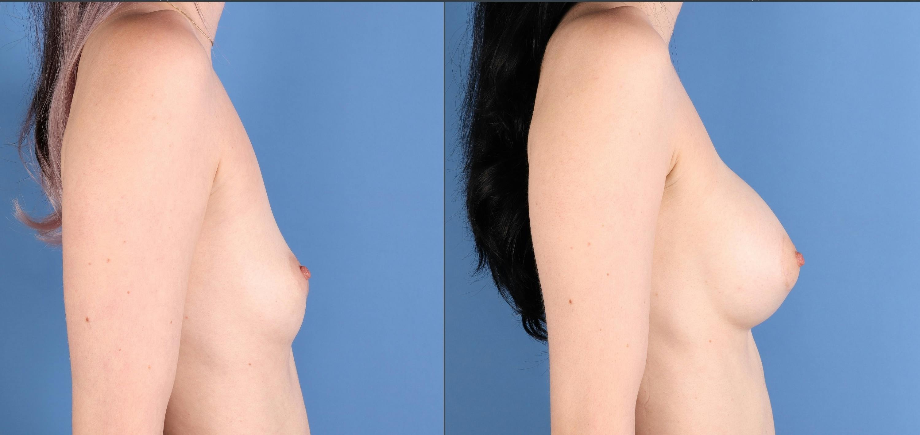 Breast Augmentation Before & After Gallery - Patient 199658 - Image 3