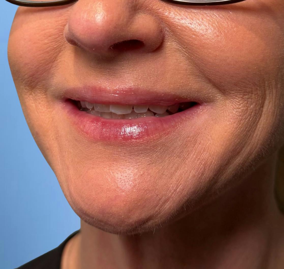 Botox Before & After Gallery - Patient 329348 - Image 2