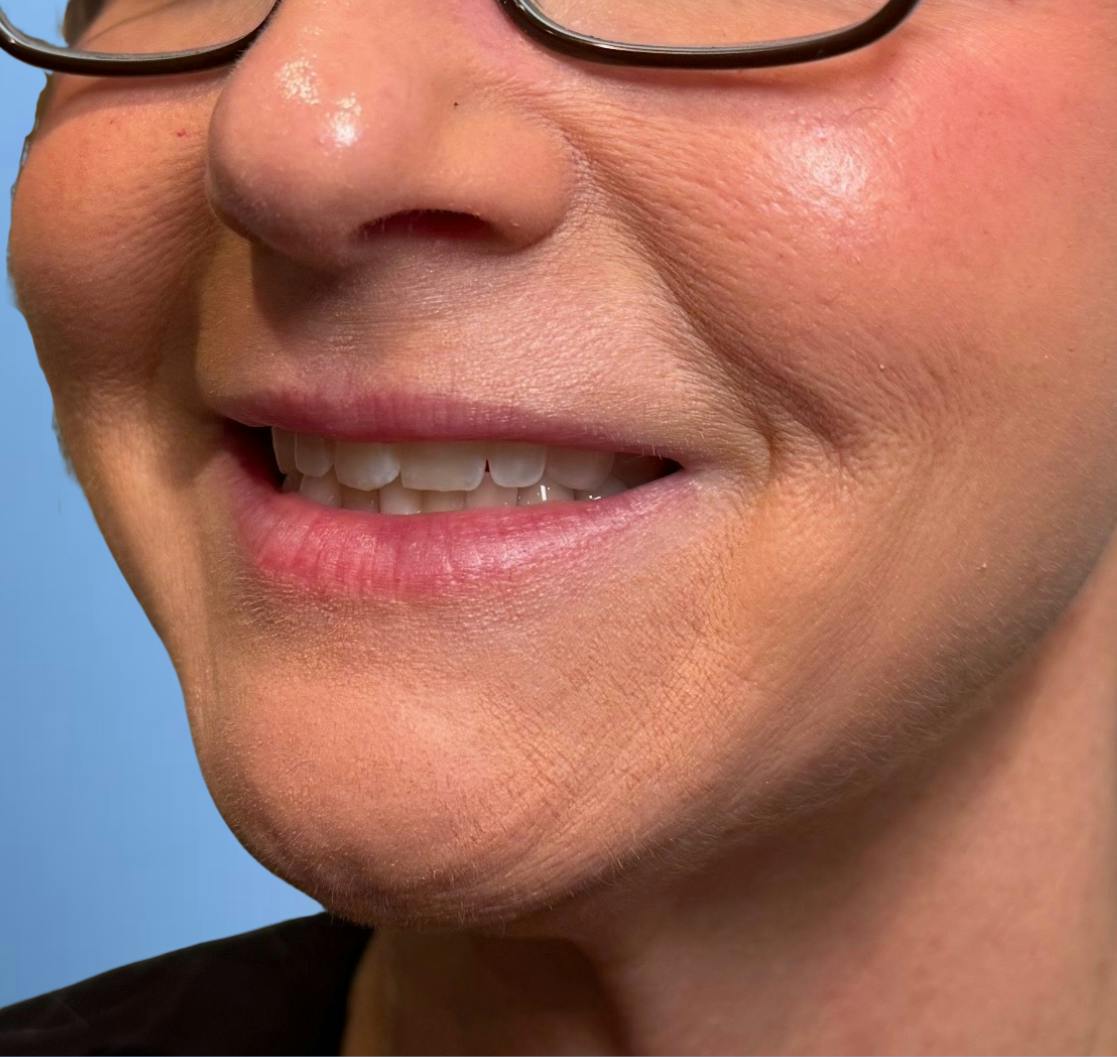 Botox Before & After Gallery - Patient 329348 - Image 1