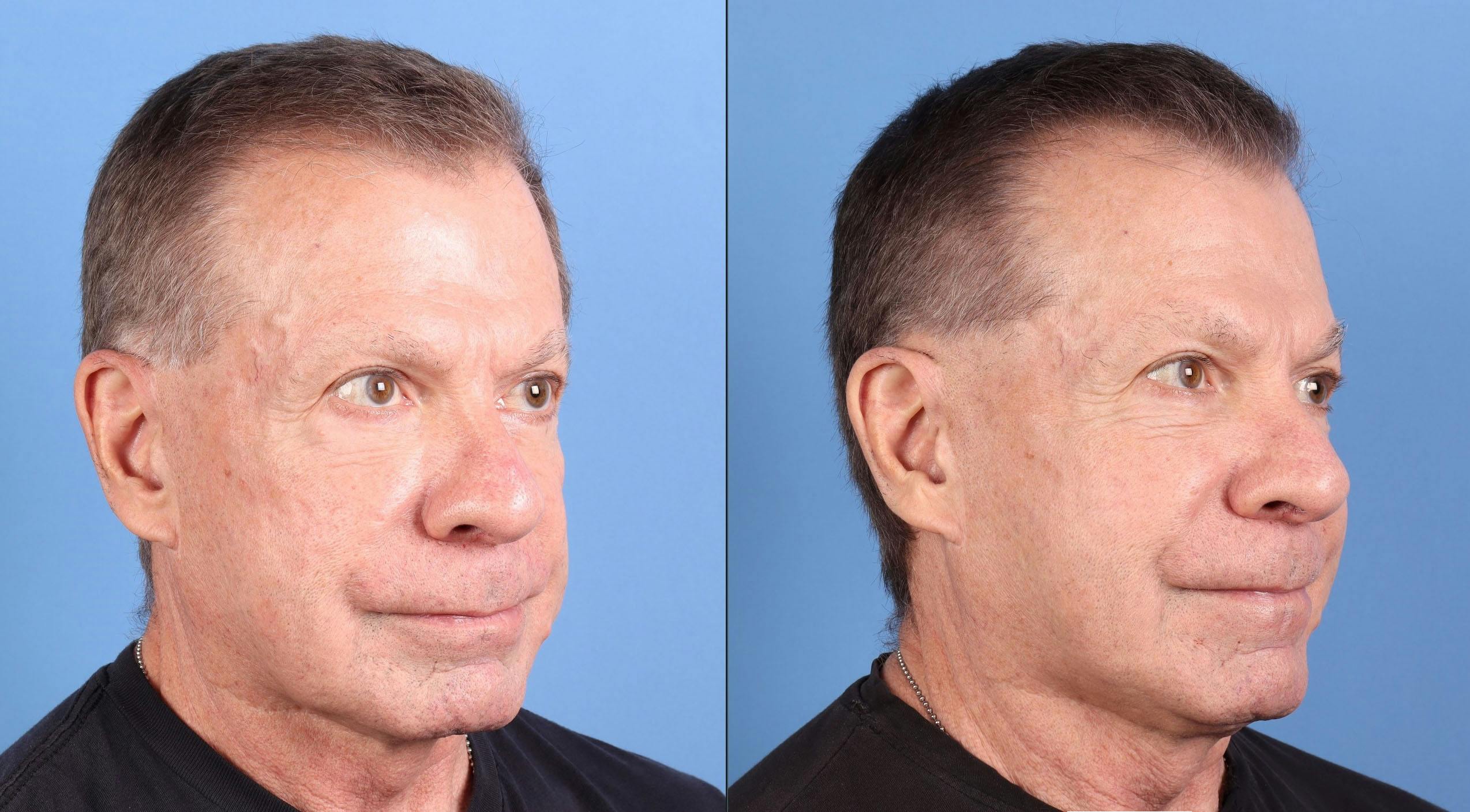 Acne Scar Treatment Before & After Gallery - Patient 327992 - Image 2