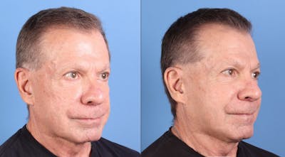 Facial Fillers Before & After Gallery - Patient 353453 - Image 1