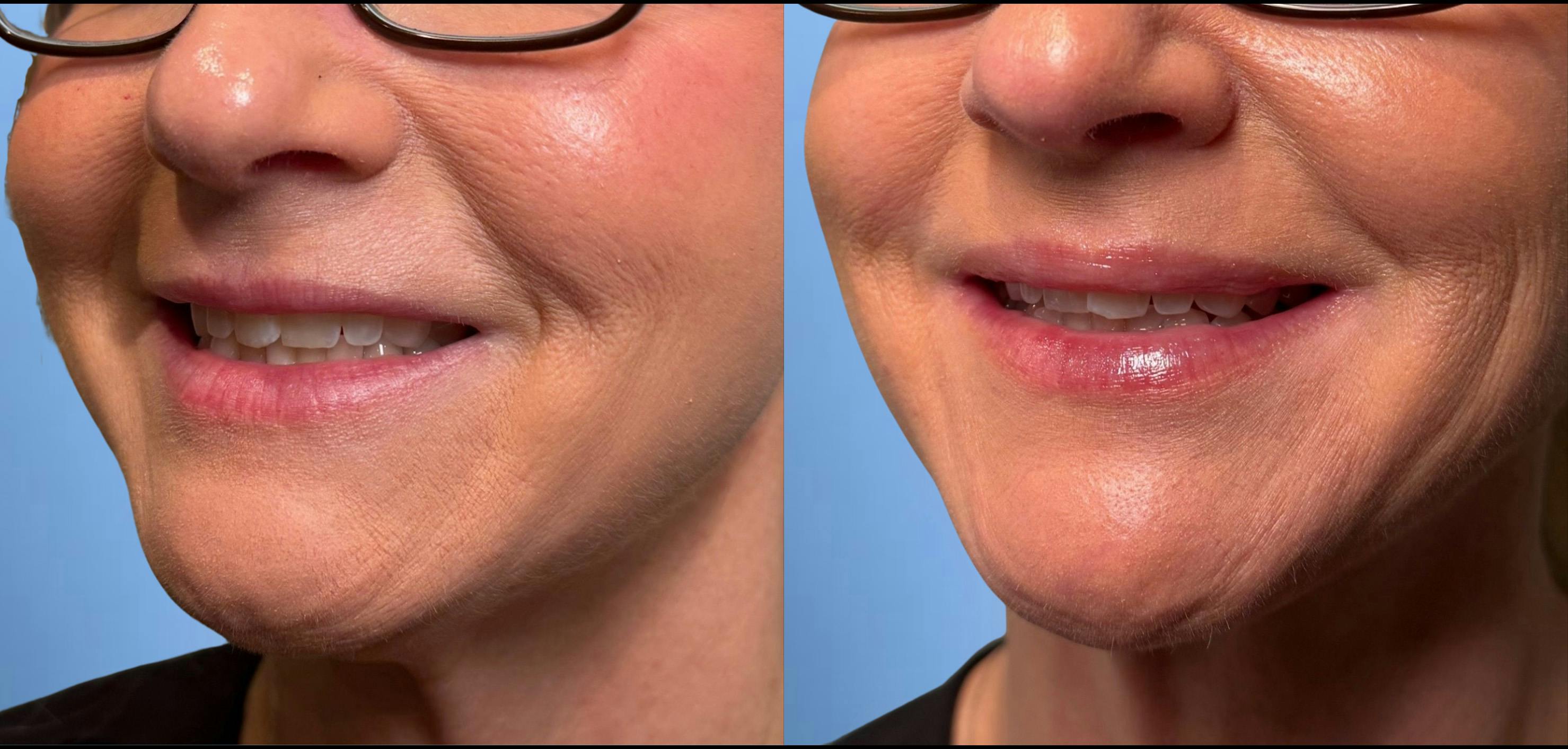 Botox Before & After Gallery - Patient 329348 - Image 1