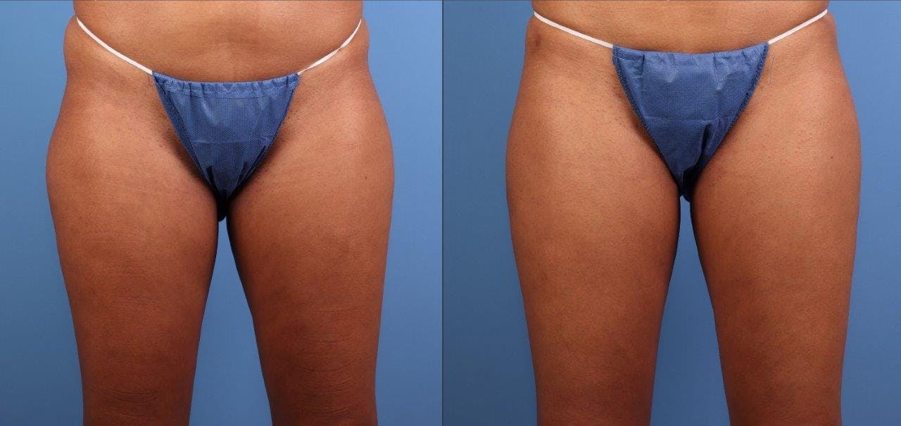 Aveli Before & After Gallery - Patient 368543 - Image 2