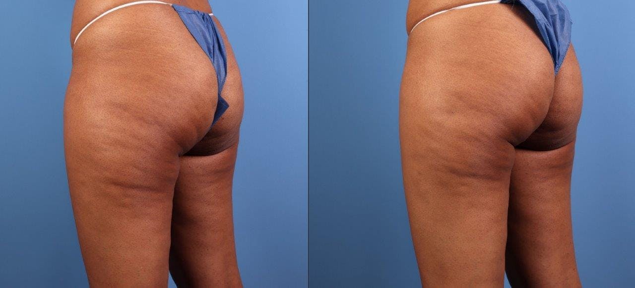 Aveli Before & After Gallery - Patient 368543 - Image 1