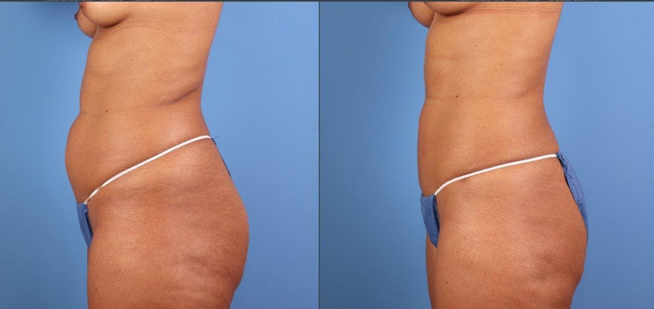 Abdomen Before & After Gallery - Patient 107661 - Image 3