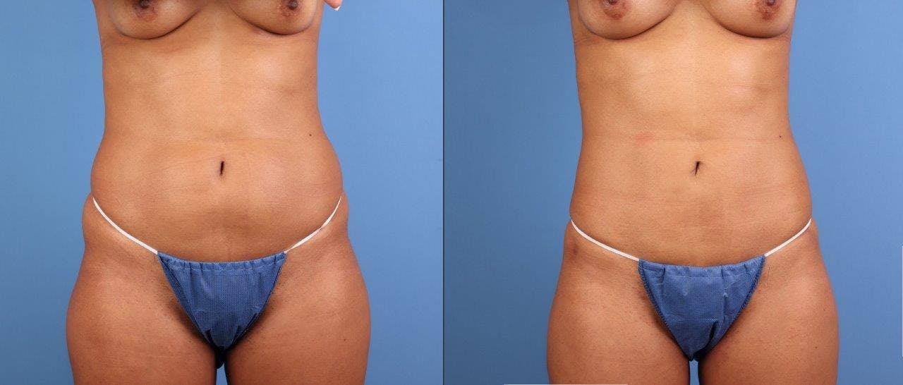 Abdomen Before & After Gallery - Patient 107661 - Image 1