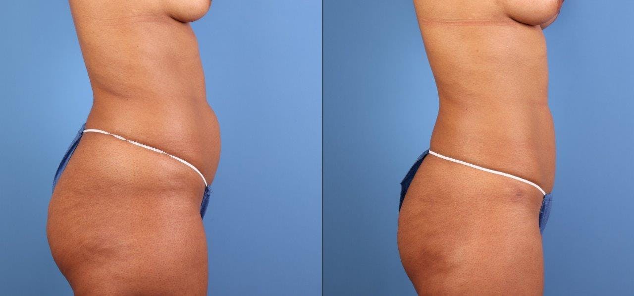 Abdomen Before & After Gallery - Patient 107661 - Image 5