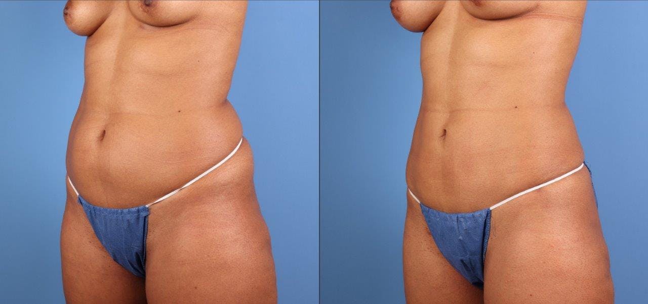 Abdomen Before & After Gallery - Patient 107661 - Image 2