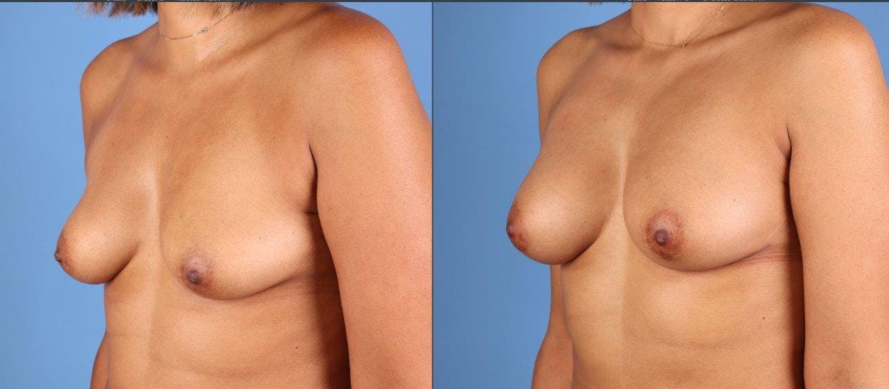 Fat Transfer Breast Augmentation Before & After Gallery - Patient 328172 - Image 4