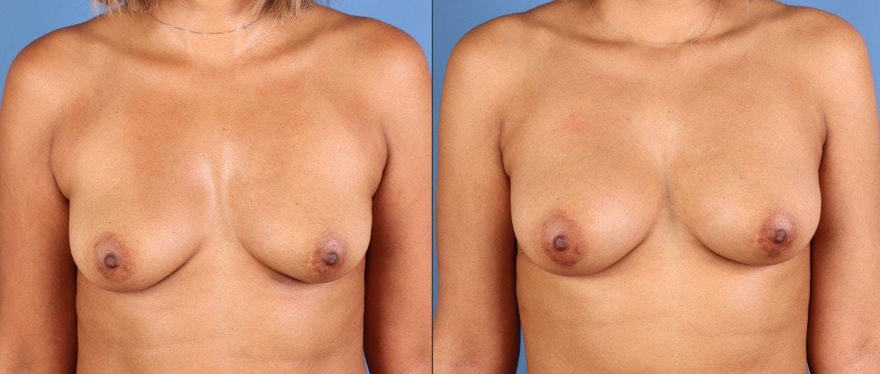 Fat Transfer Breast Augmentation Before & After Gallery - Patient 328172 - Image 1