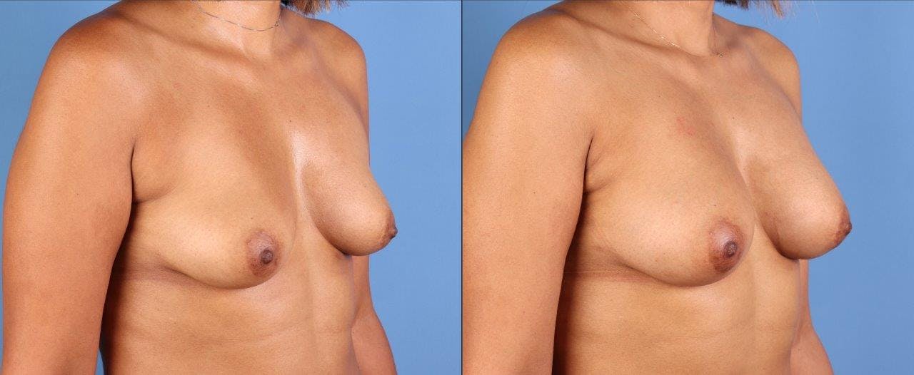 Fat Transfer Breast Augmentation Before & After Gallery - Patient 328172 - Image 2
