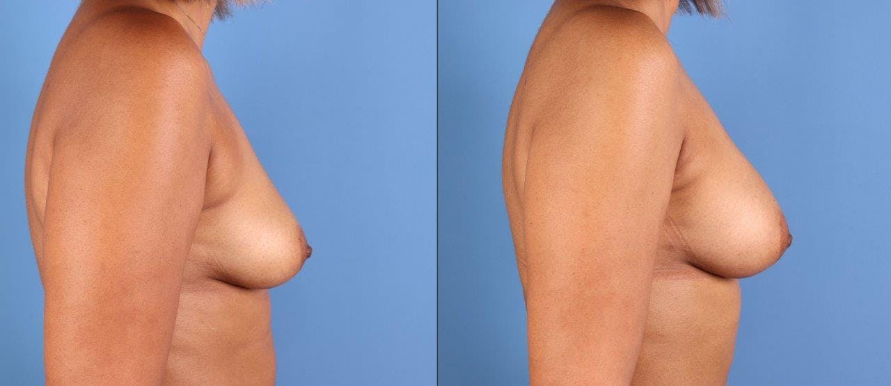 Fat Transfer Breast Augmentation Before & After Gallery - Patient 328172 - Image 3