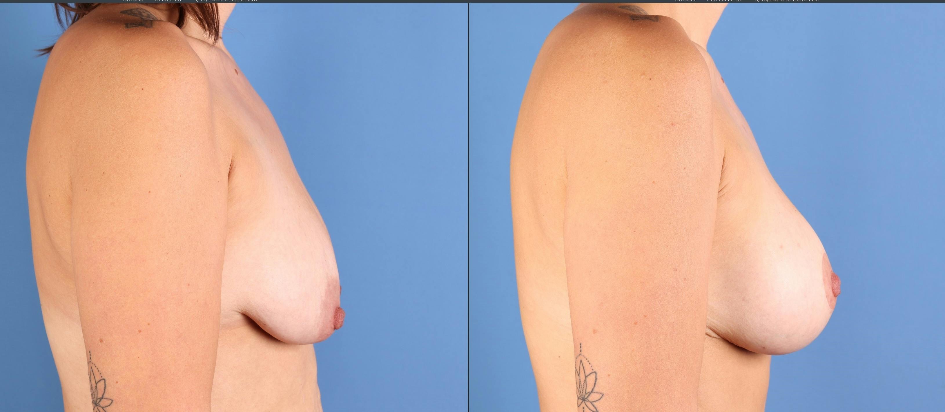 Mommy Makeover Before & After Gallery - Patient 427407 - Image 6