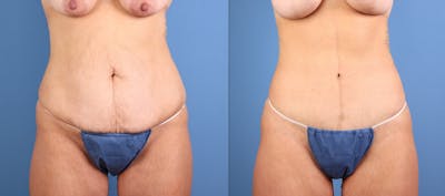 Tummy Tuck Before & After Gallery - Patient 295766 - Image 1